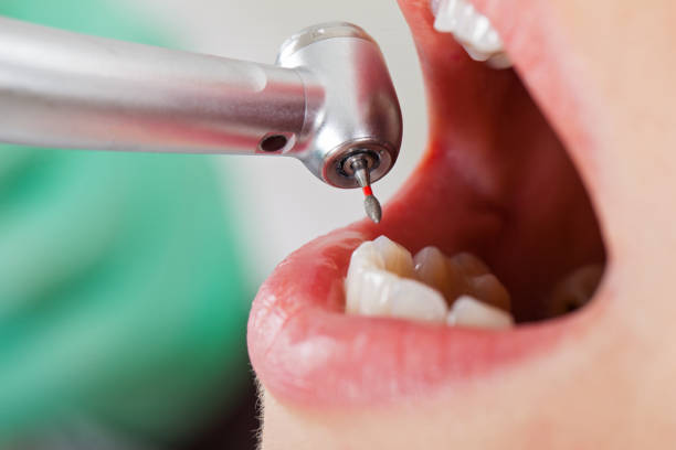 Best Emergency Root Canal Treatment in Mcarthur, OH